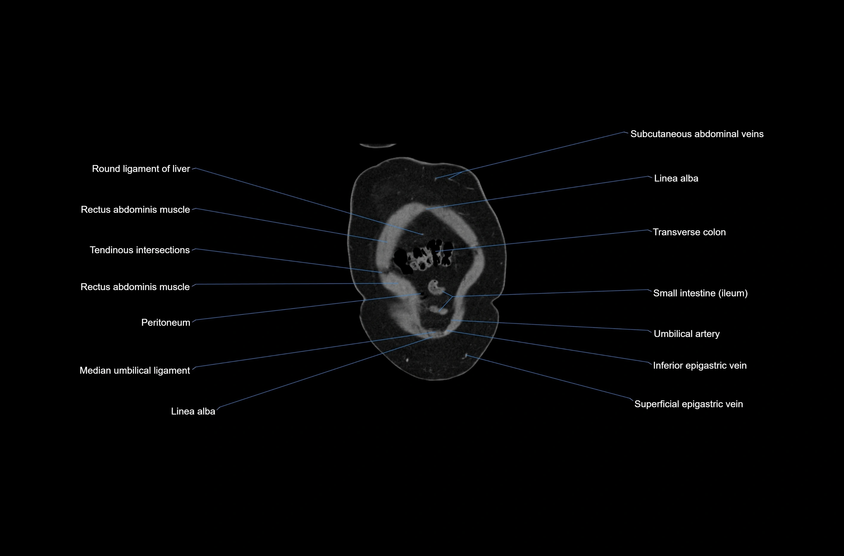 CT abdomen coronal cross sectional anatomy labelled radiology image-00007.webp